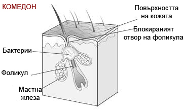 Комедон