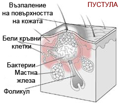 Пустула